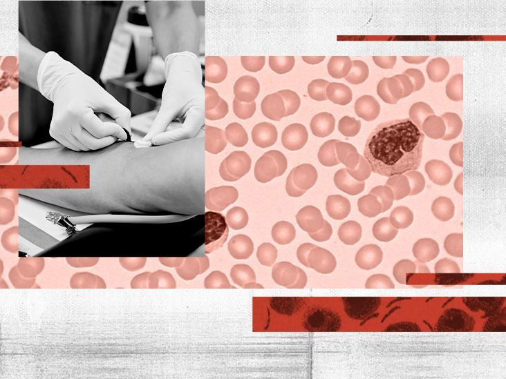 What Causes a Low Platelet Count (Thrombocytopenia)?