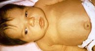 Breast Milk Jaundice: Causes, Symptoms & Diagnosis
